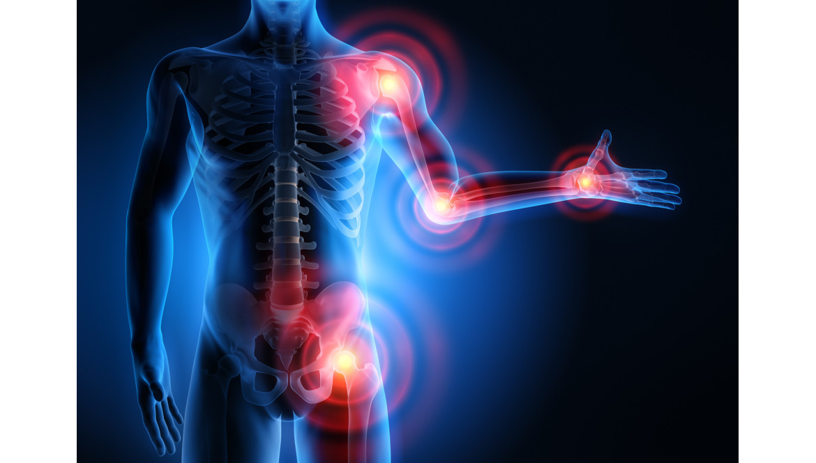 Comment soulager l'arthrose ?
