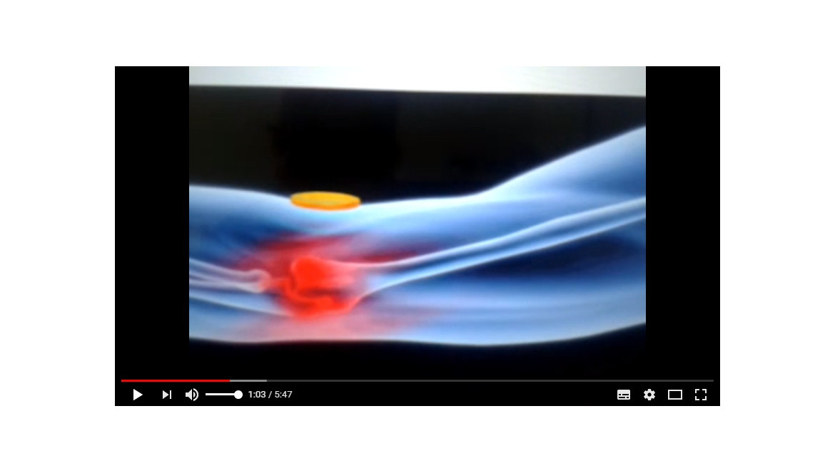 Magnetotherapie : Remplacer les anti-inflammatoires par des aimants